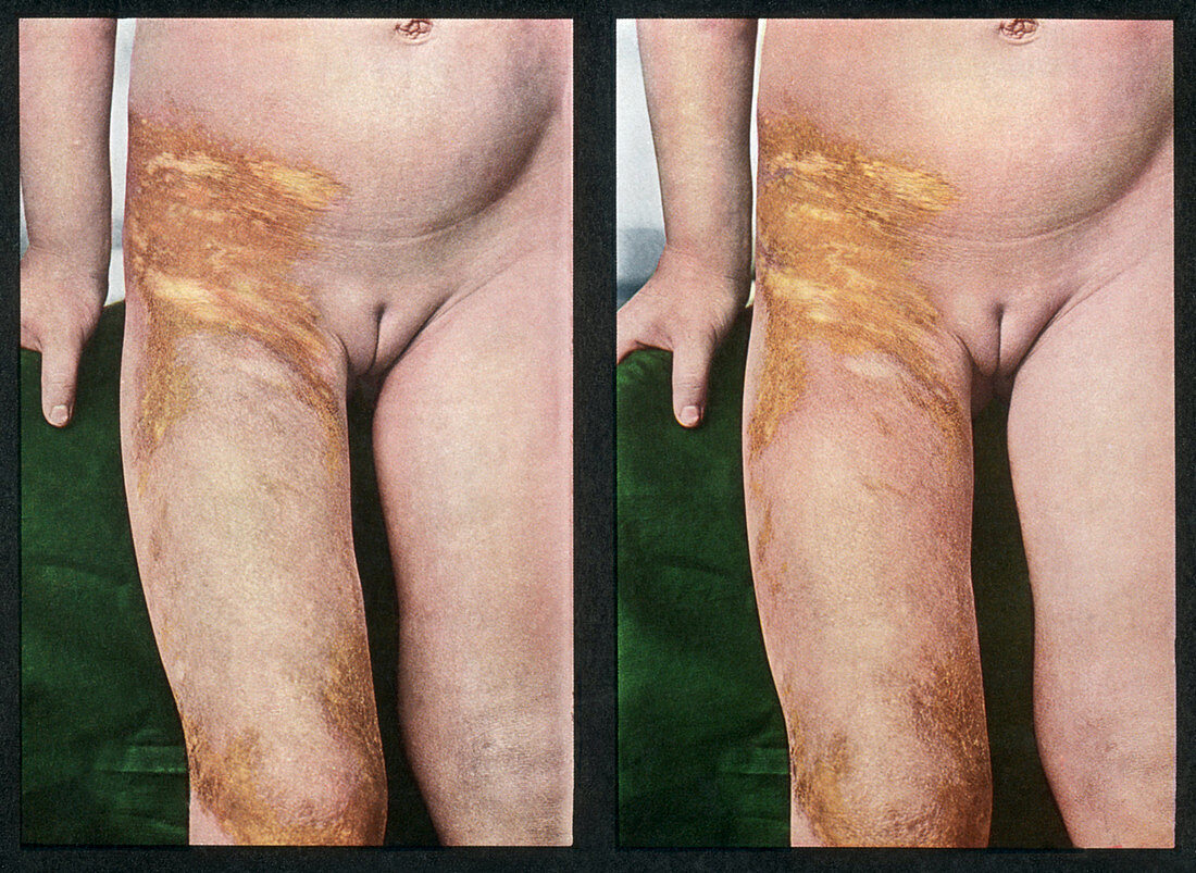 Scleroderma,Vintage Stereoscopic Image