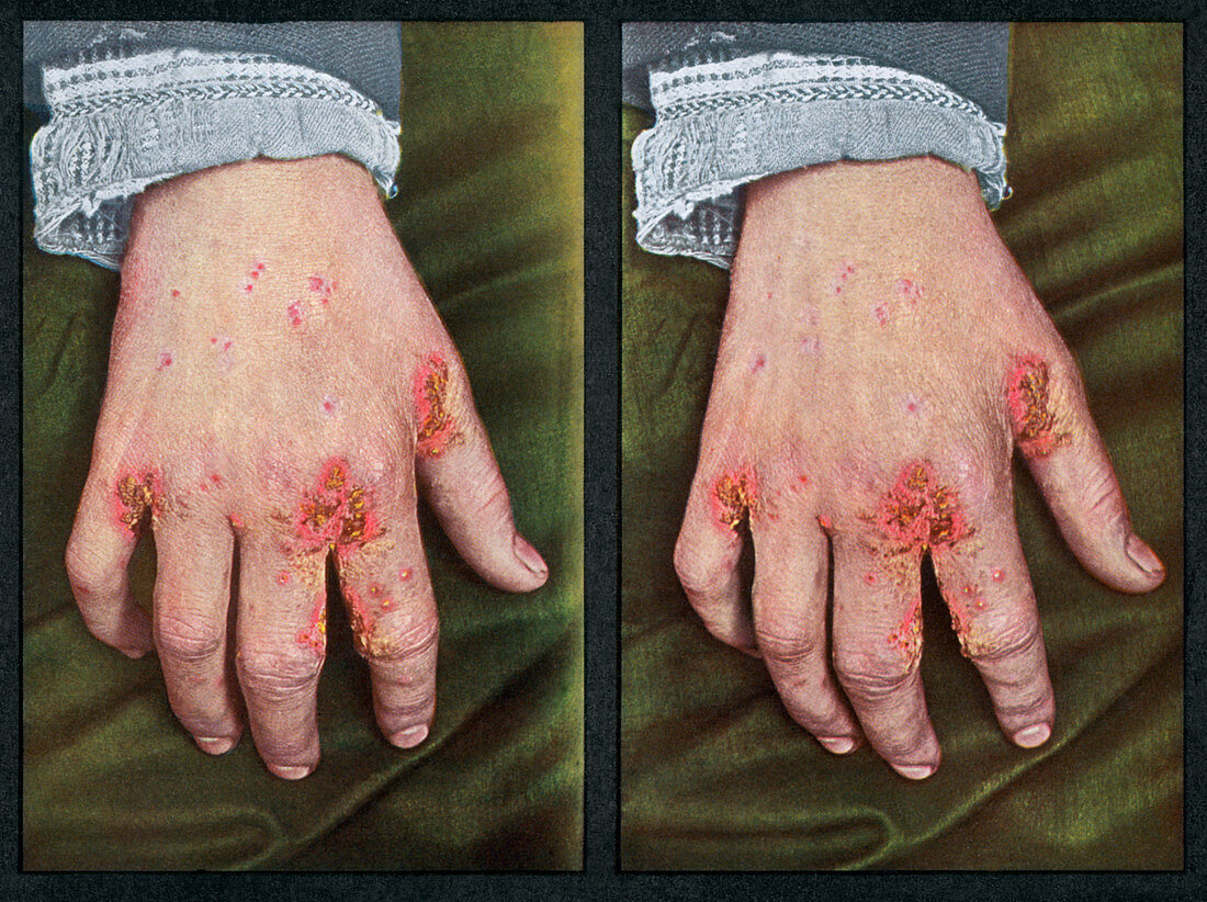 Scabies,Vintage Stereoscopic Image