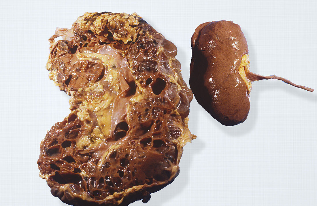 Polycystic and Normal Kidneys