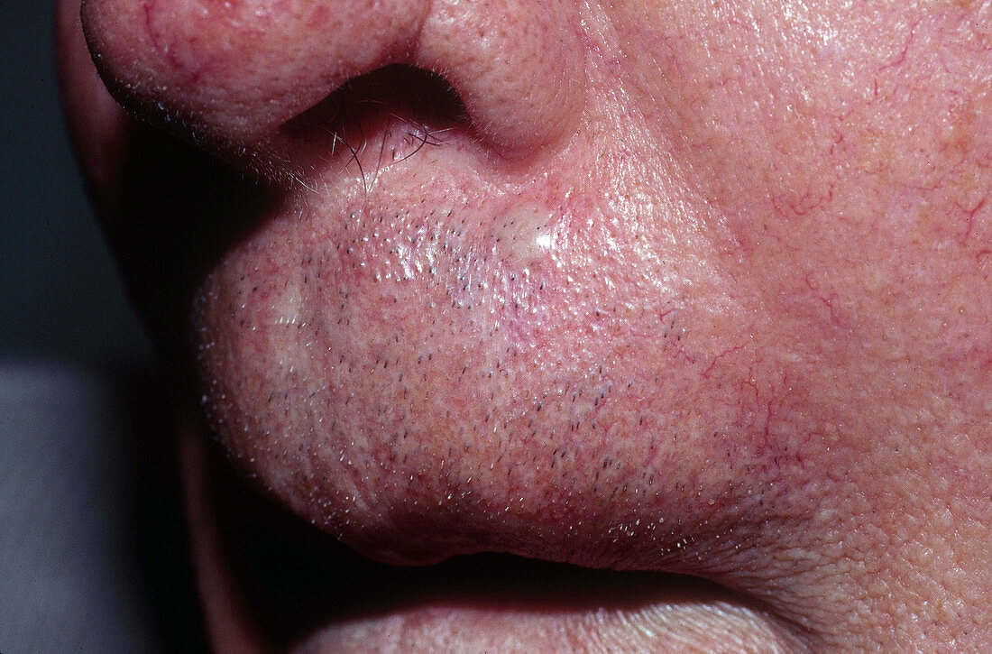 Basal Cell Carcinoma above Lip
