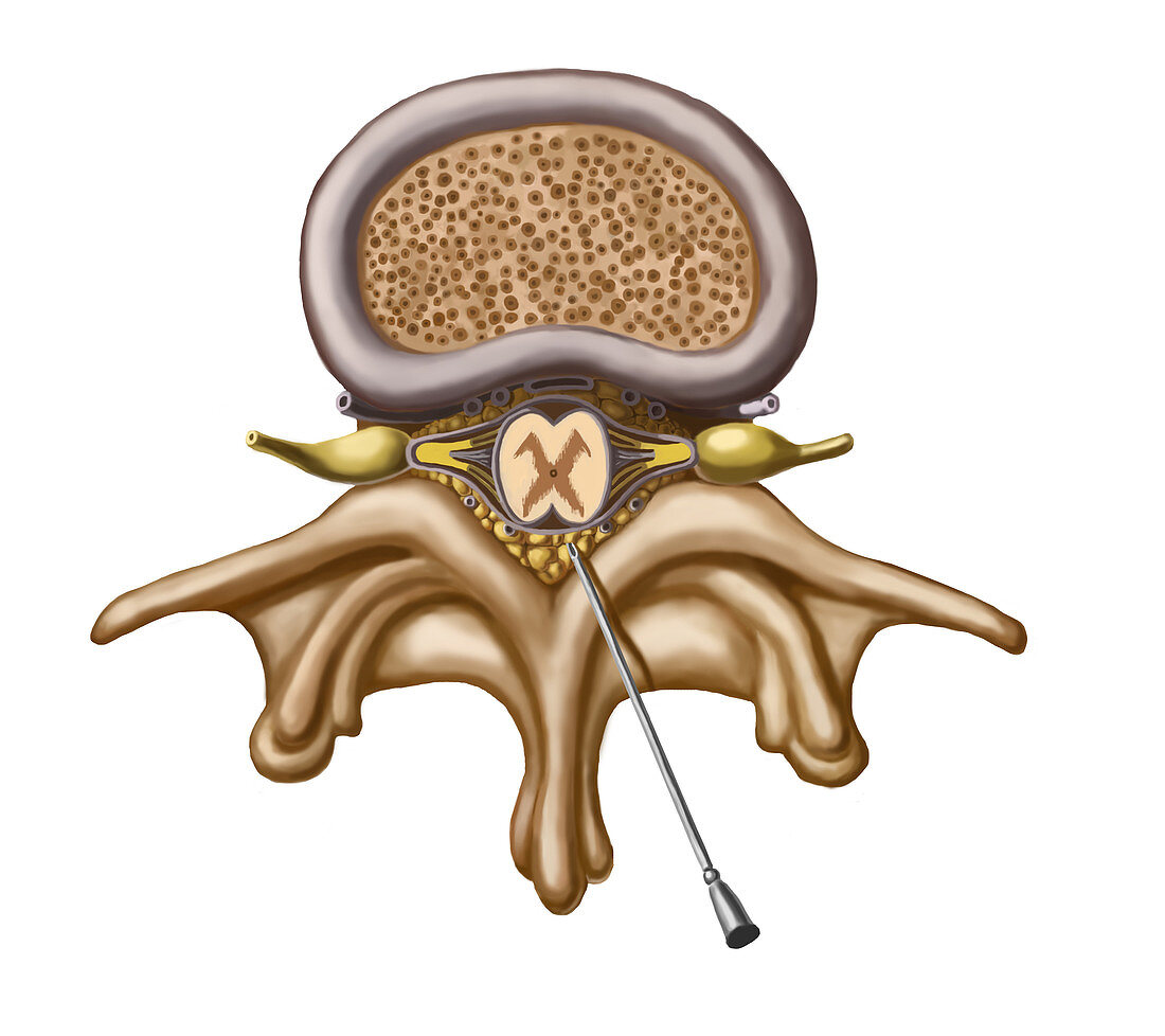 Spinal Tap