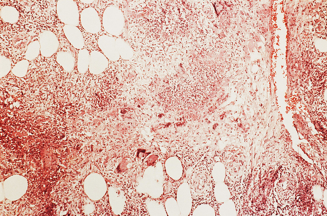 Erythema Nodosum,LM