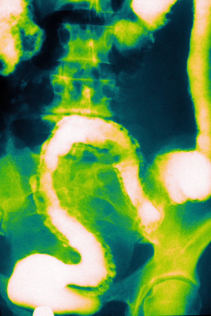 Ulcerative Colitis (X-ray)