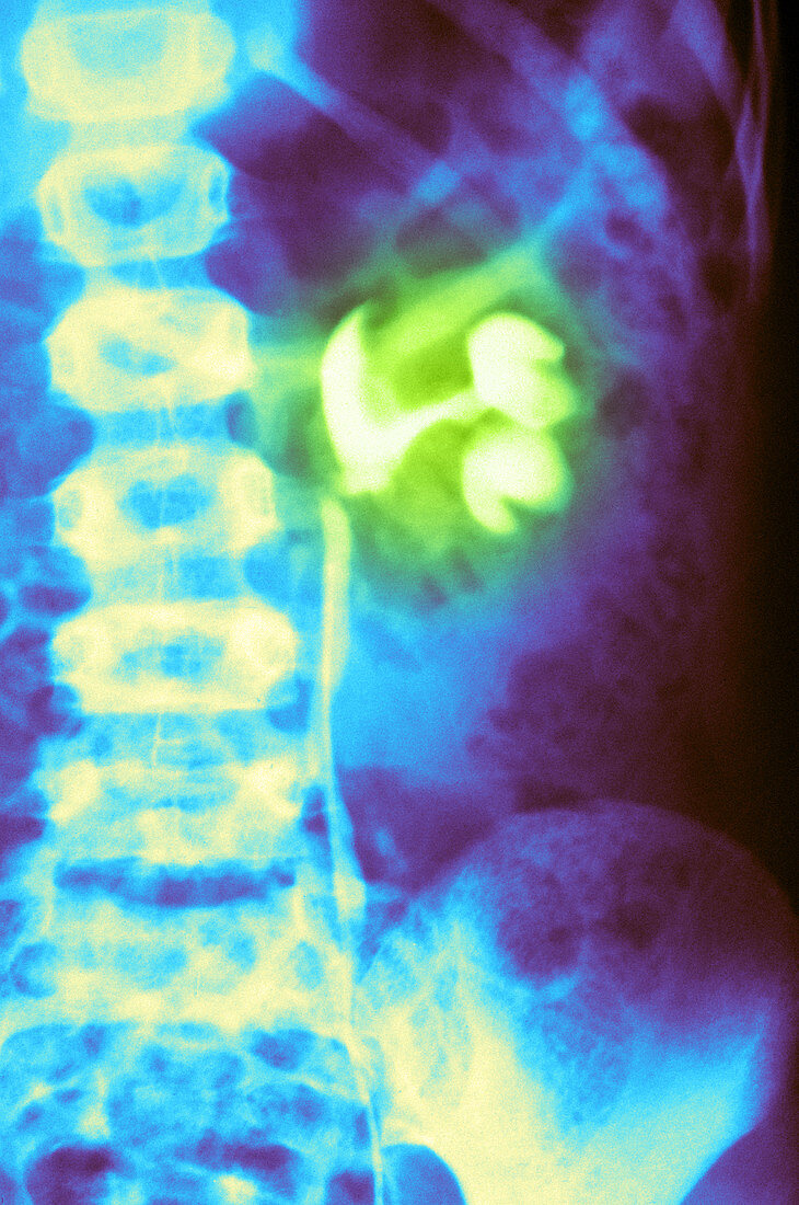 Kidney Tumor,X-ray