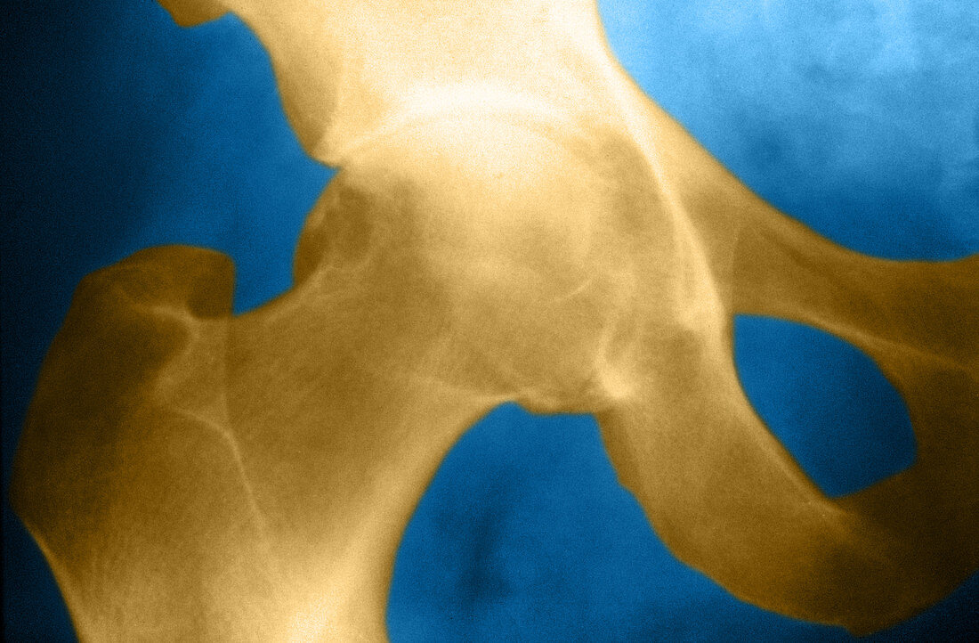 Osteoarthritis of the Hip,X-ray