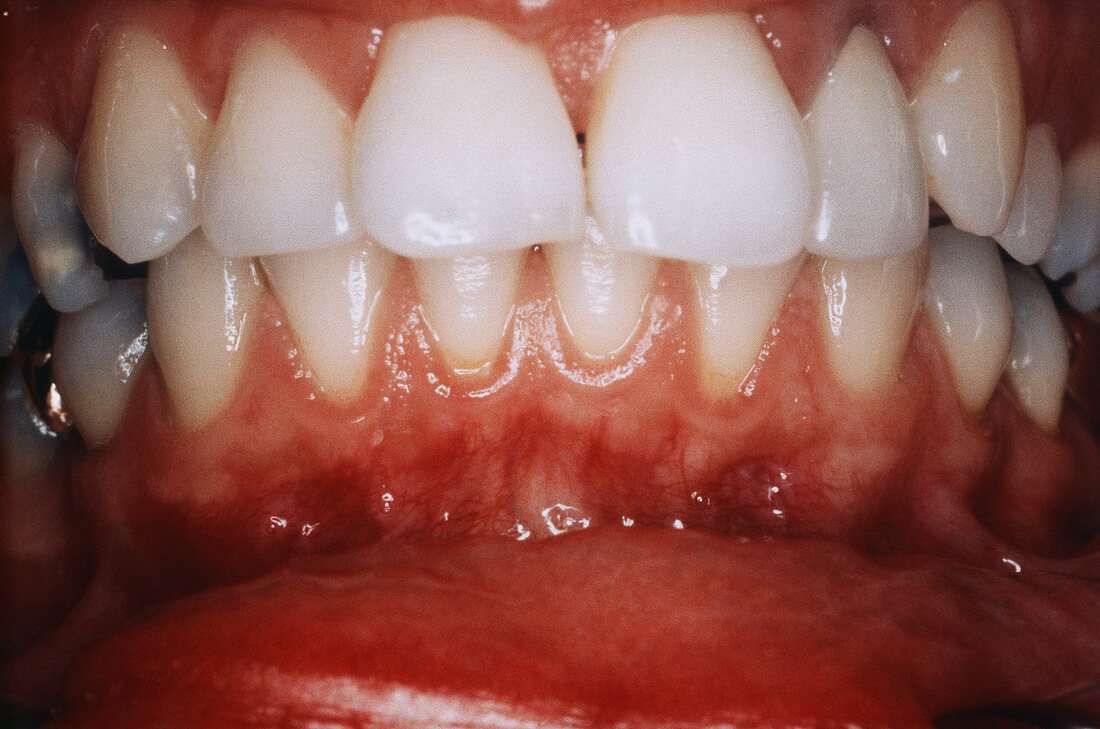 Attached Gingiva
