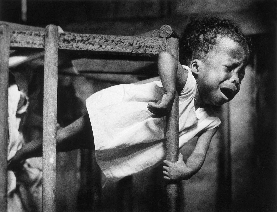 Malnourished Child,Colombia