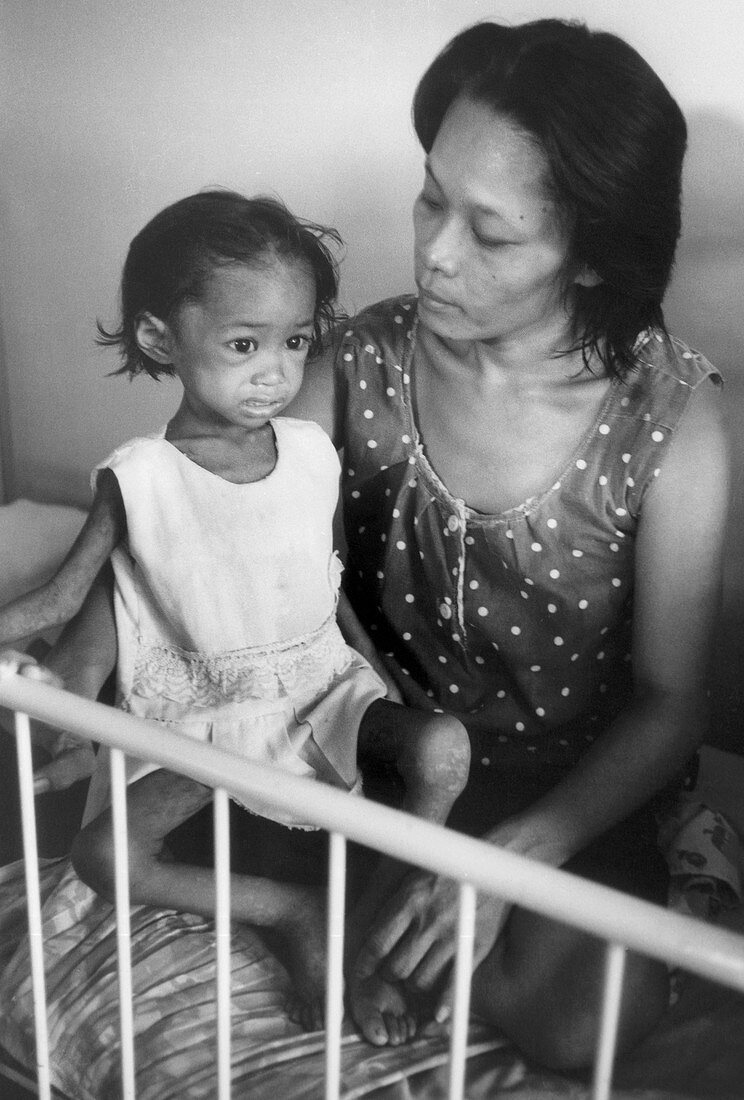 Malnourished Child,Philippines