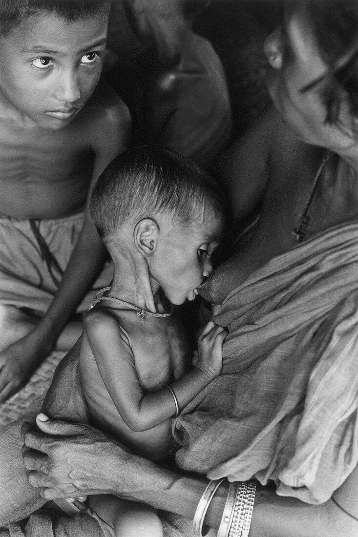 Malnourished Child,Bangladesh