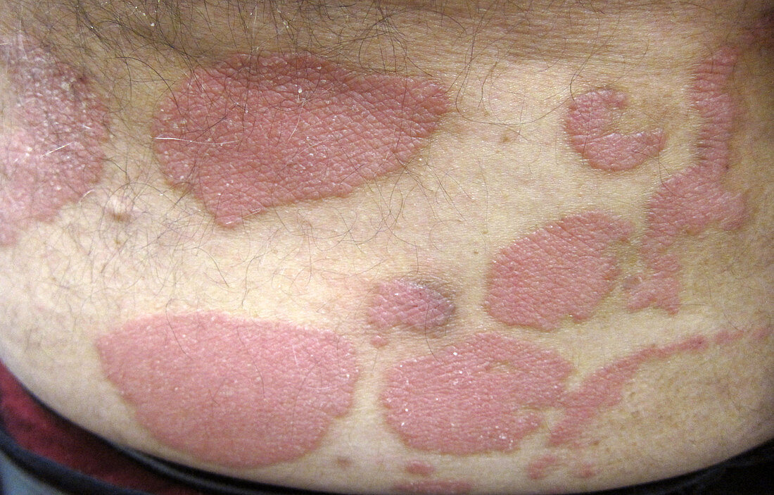 Psoriasis