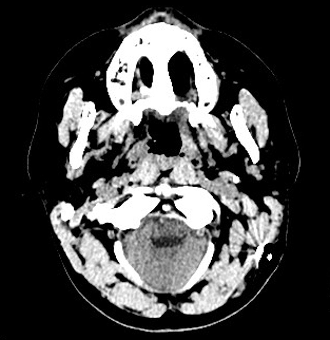 Arnold-Chiari Malformation (CT Scan)