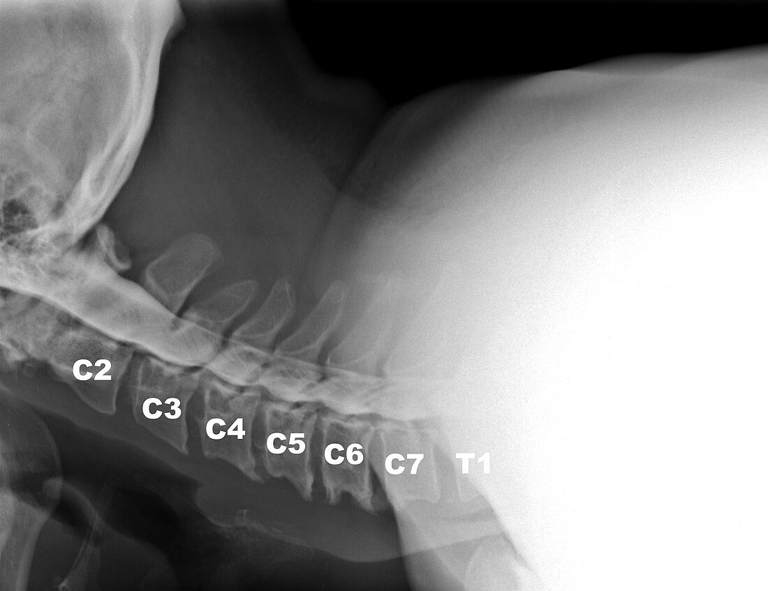 Cervical Myelogram (X-ray)