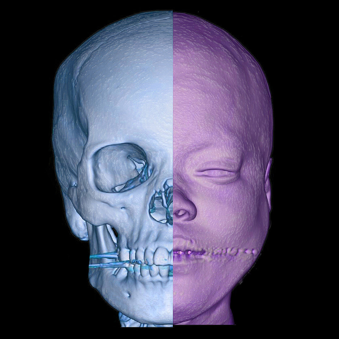 Human Face and Skull,Enhanced 3D CT Scan