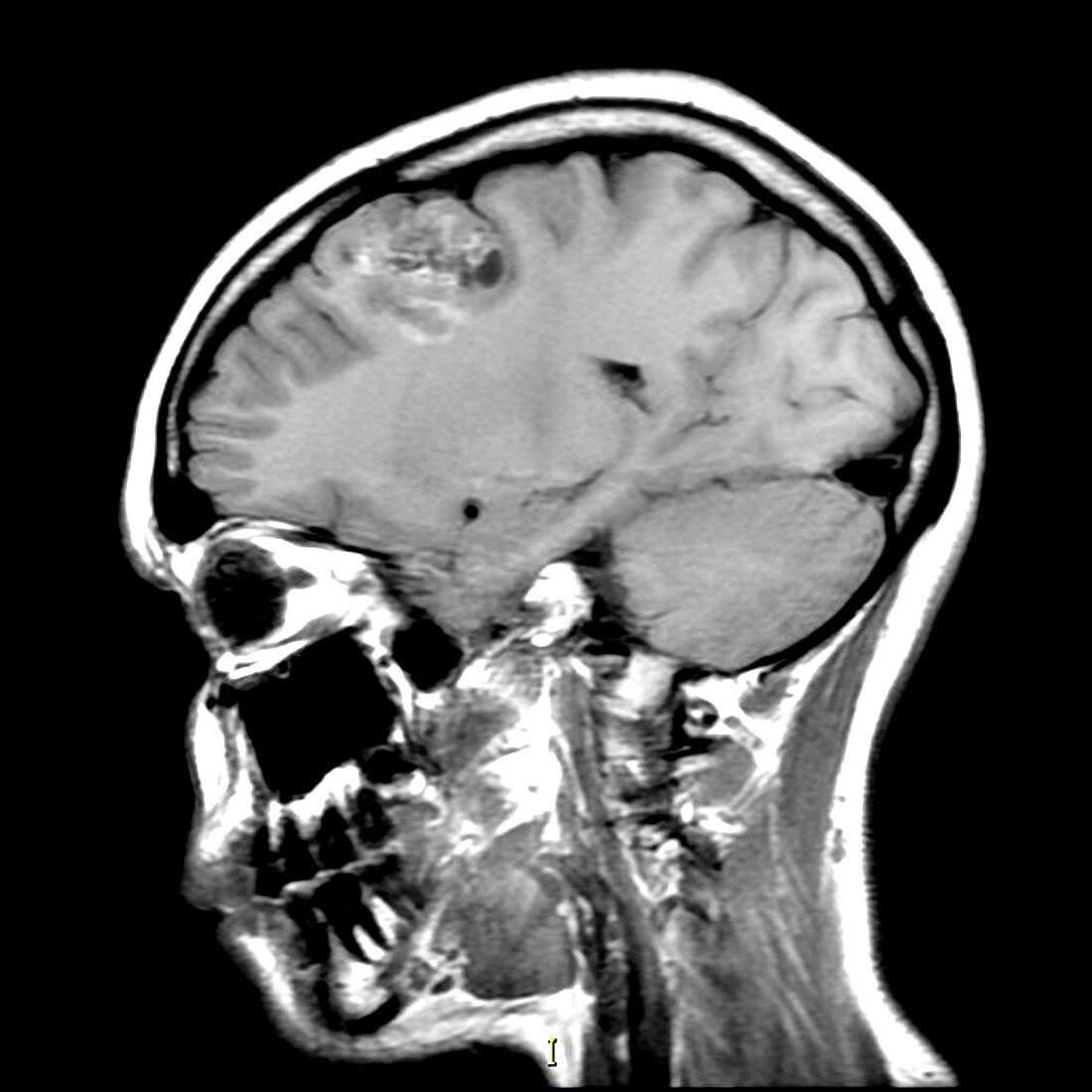 Oligodendroglioma (MRI)