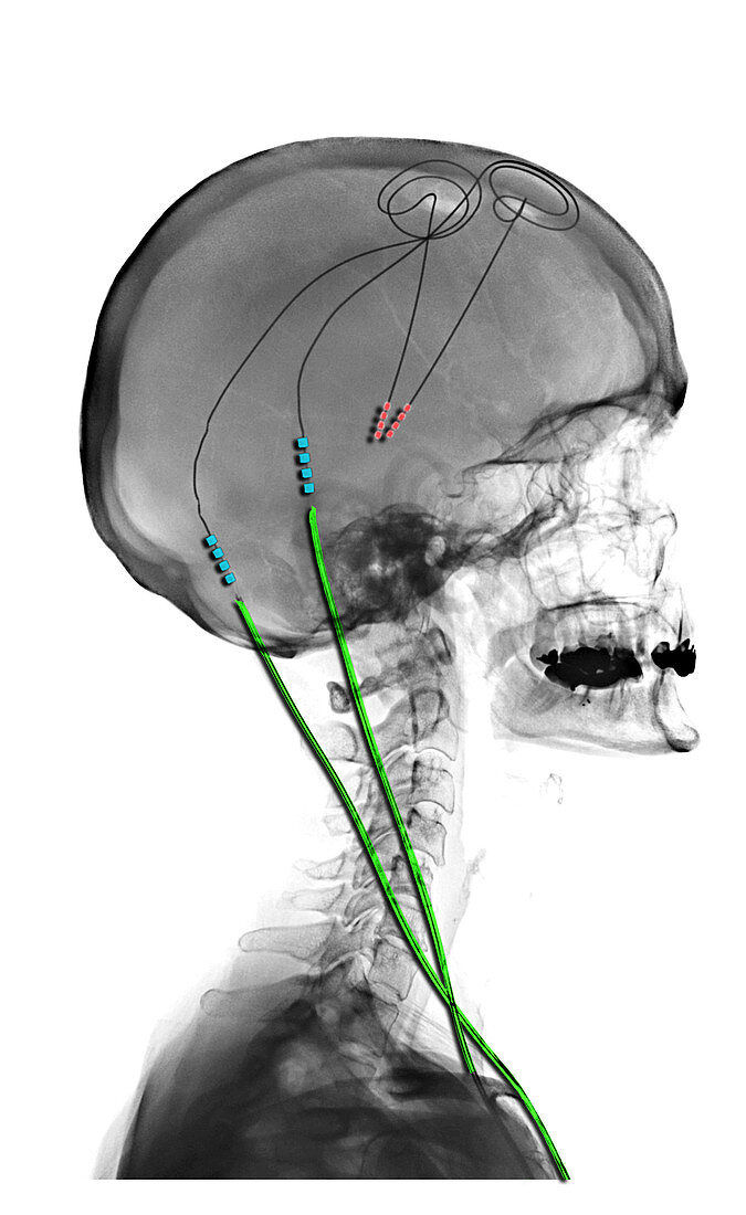 Parkinson's Disease with DBS Electrodes