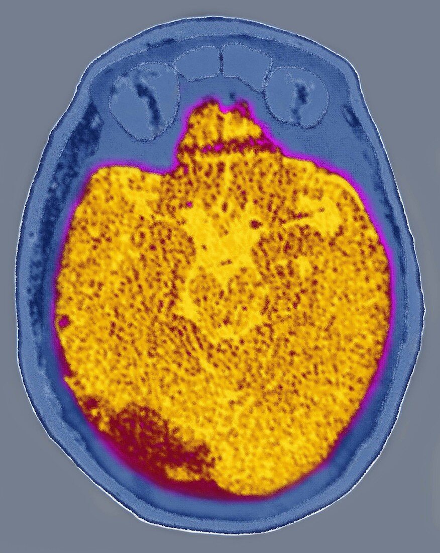Brain Stroke,MRI