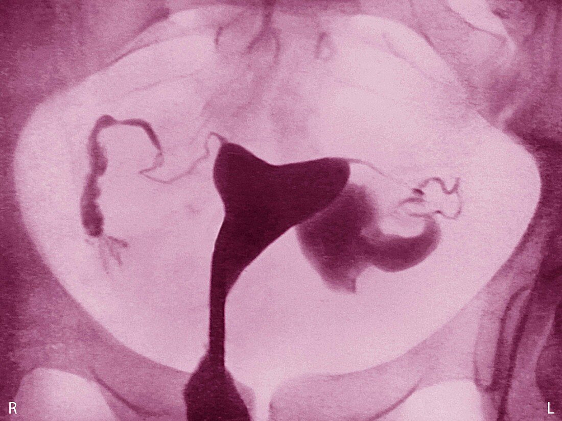 Hysterosalpingograph of Hydrosalpinx