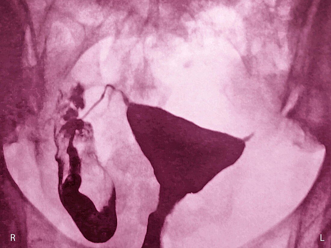 Fallopian Tube Obstruction,Hysterography