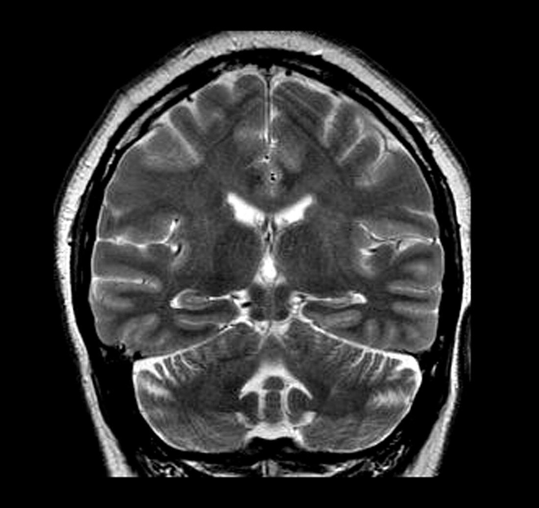 MRI of Mesial Temporal Sclerosis