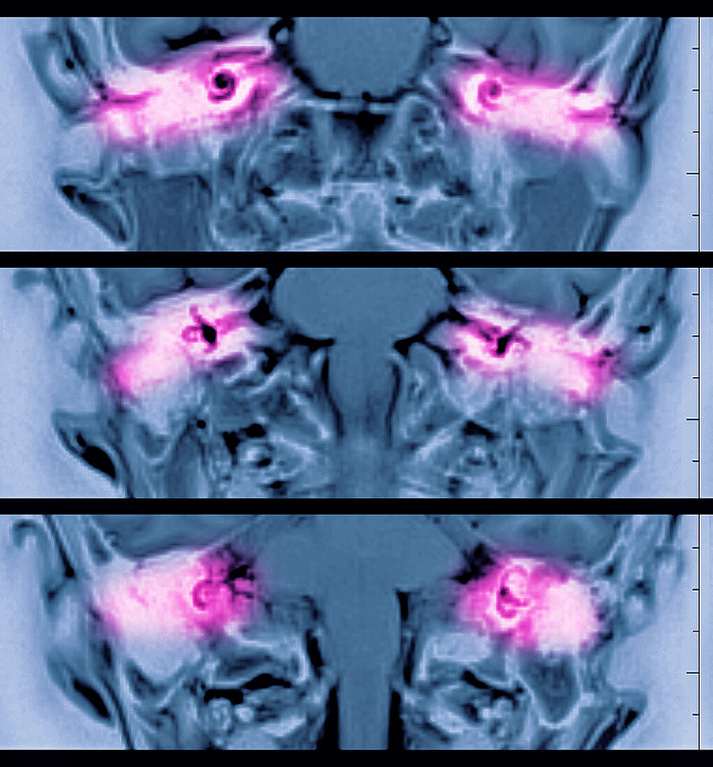 MRI of Inner ear
