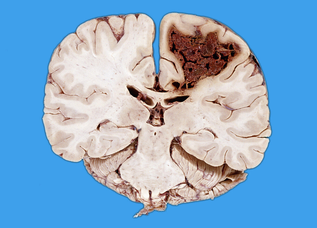 Cerebral Infarction from Embolus