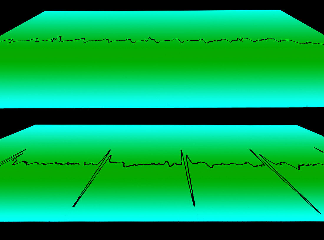 Atrial Flutter and Normal Heart Beat
