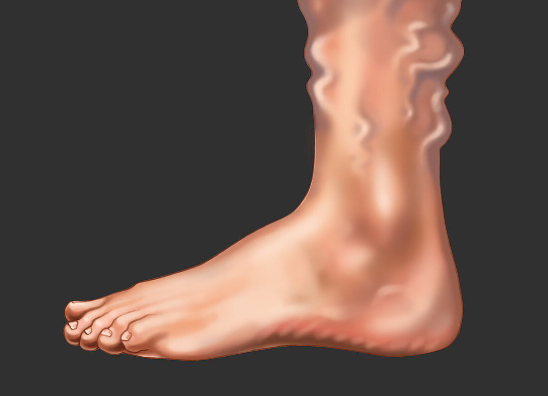 Varicose Veins on the Foot and Ankle