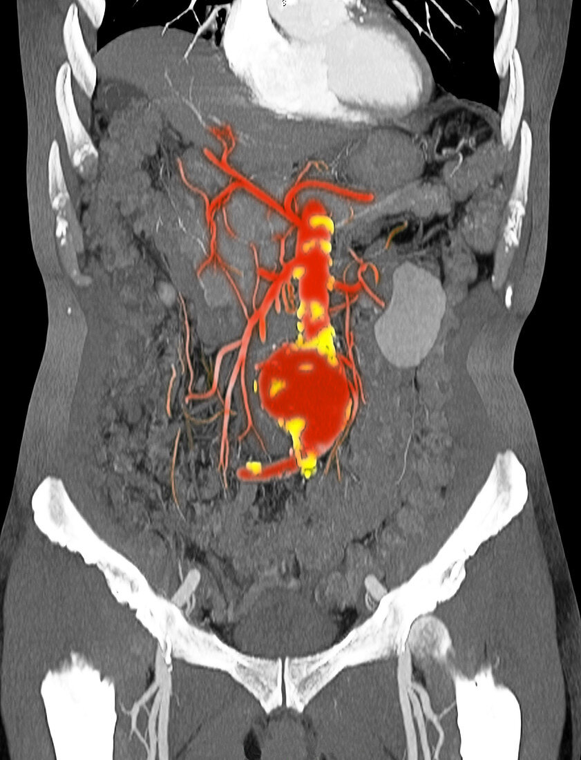 CT Scan of Abdominal Aortic Aneurysm