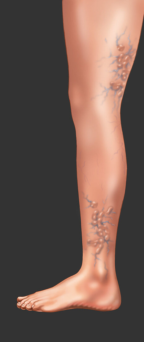 Varicose Veins