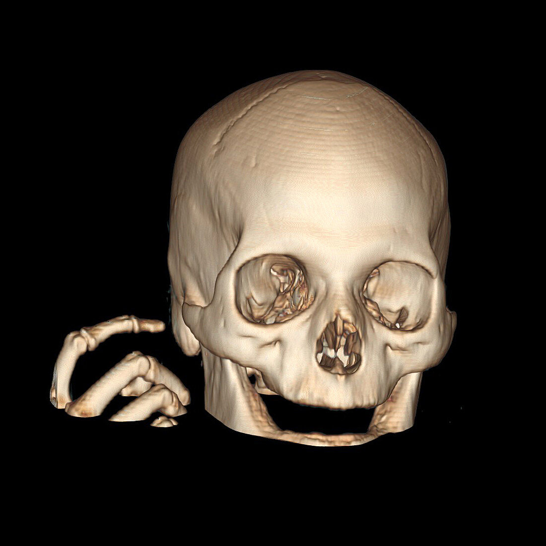 3D CT Reconstruction of Head and Hand