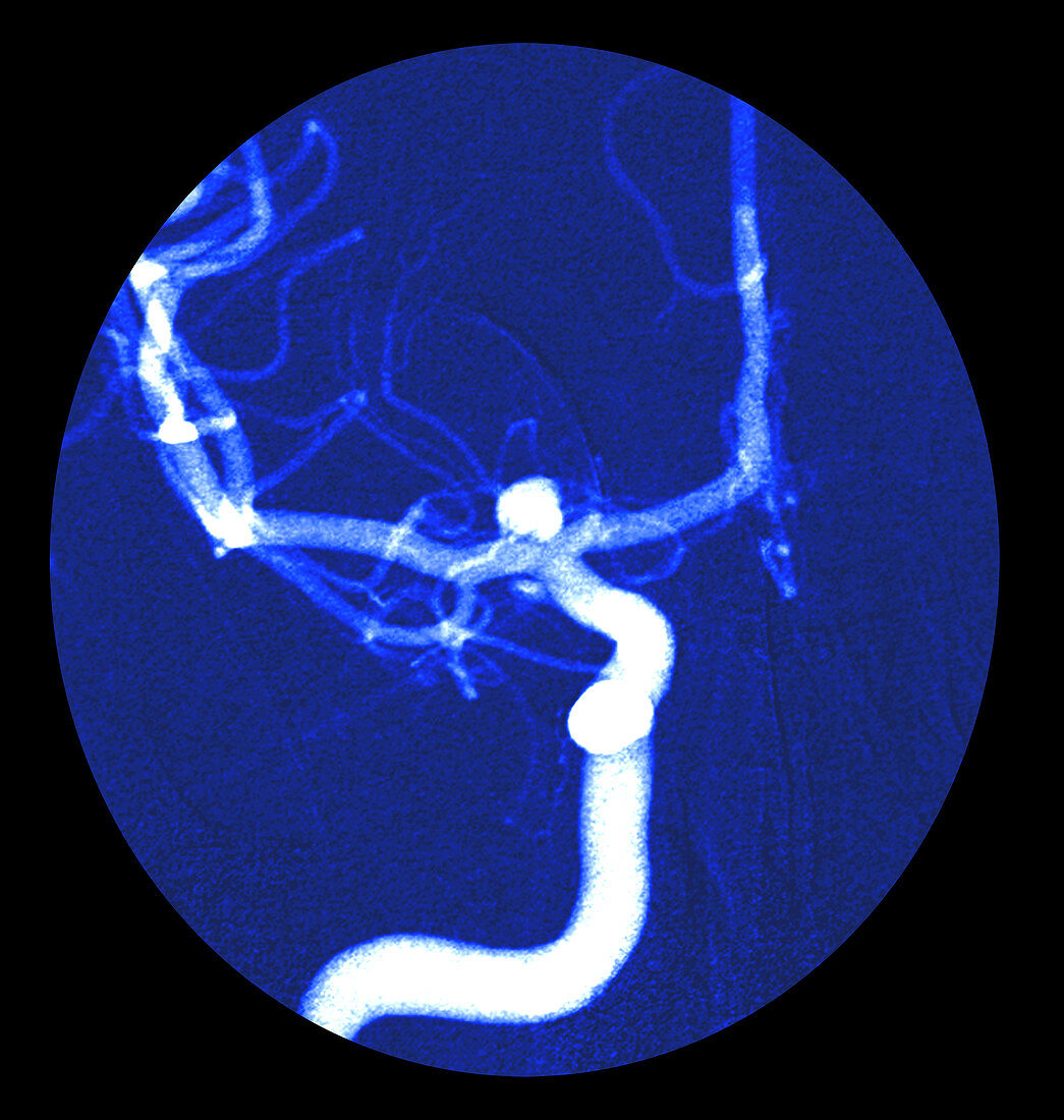 Cerebral Angiogram of Aneurysm