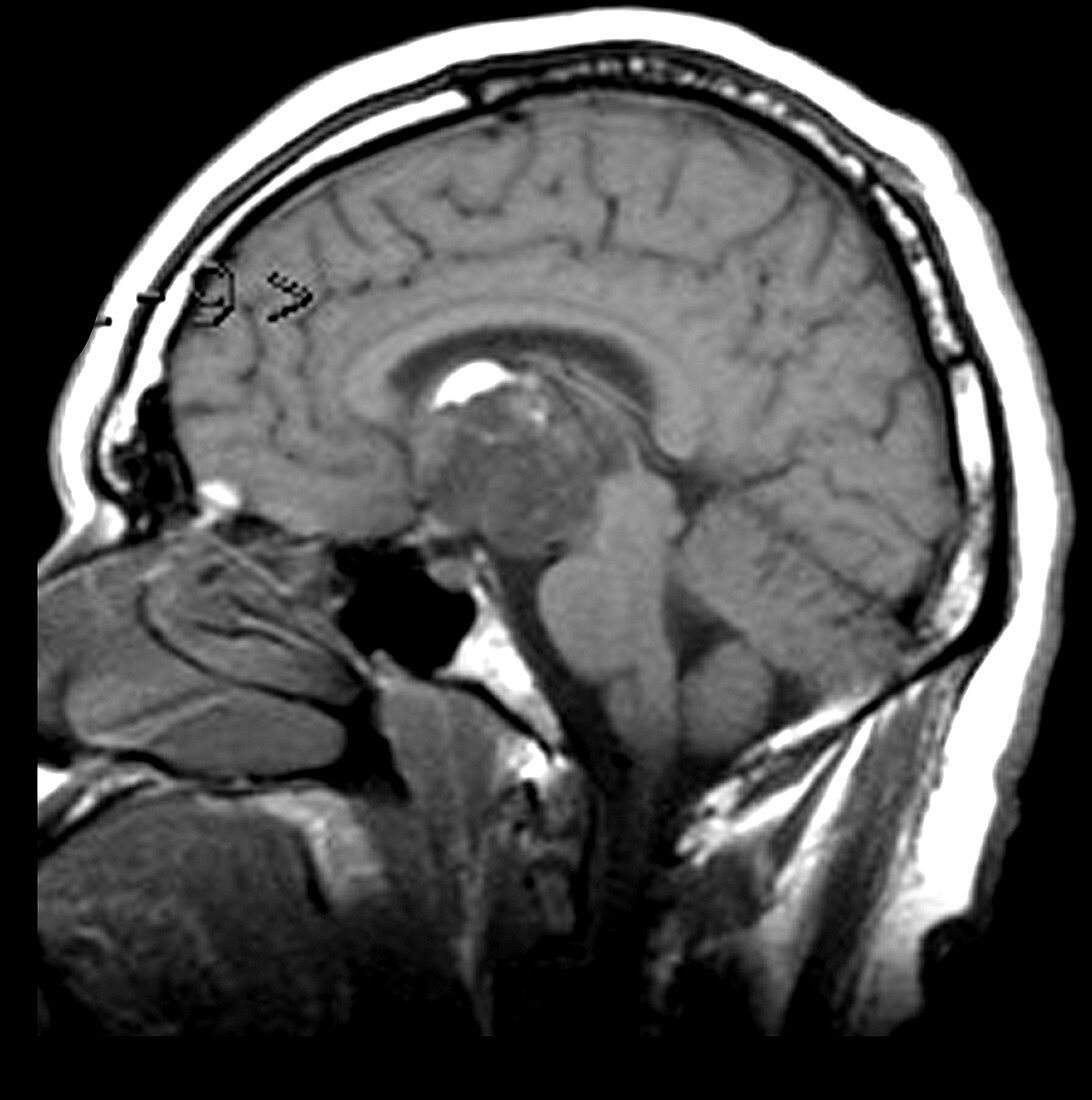 Craniopharyngioma (MRI)