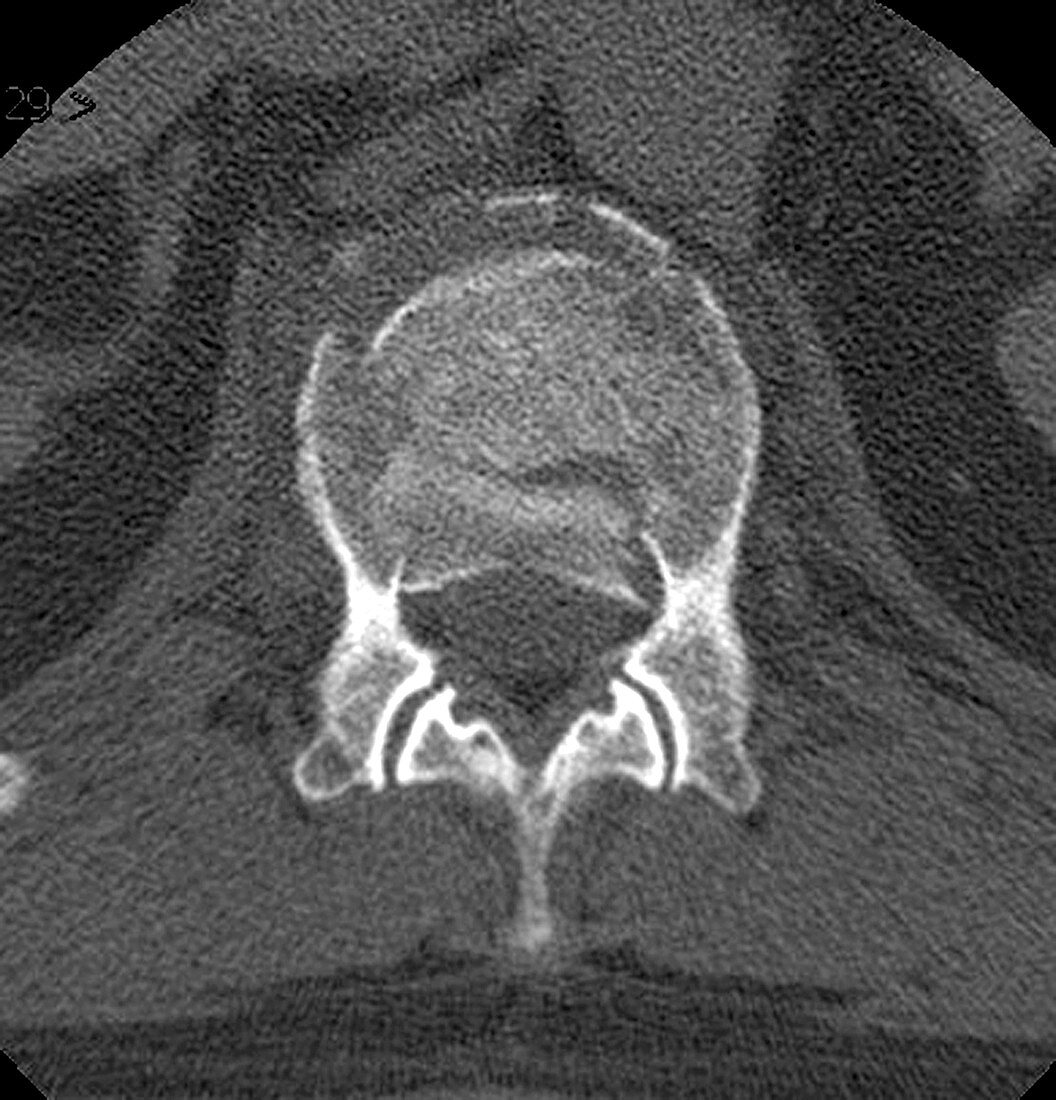 Burst Compression Fracture (CT Scan)