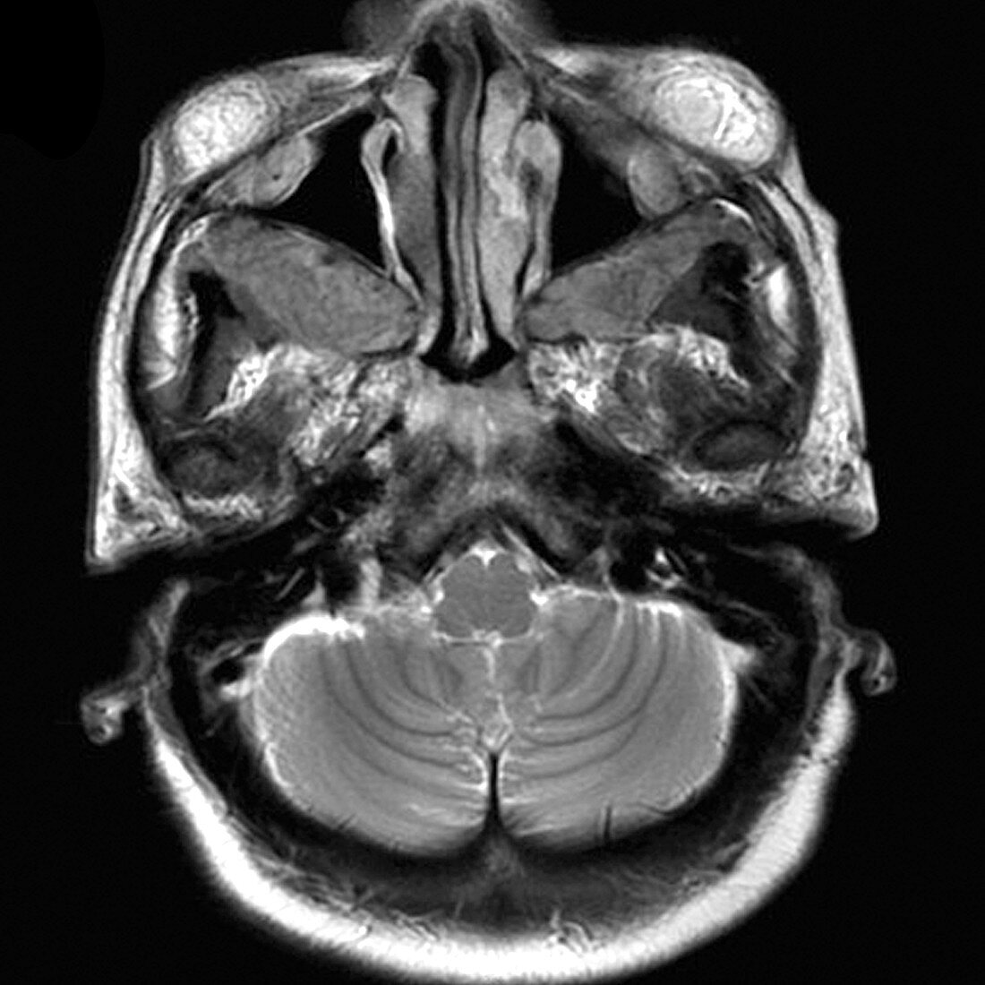 Orbital and Deep Facial Lymphoma (MRI)