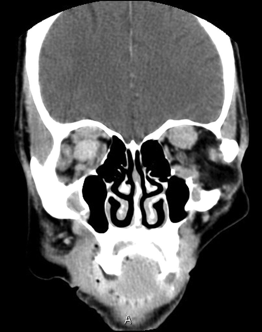 Orbital and Deep Facial Lymphoma