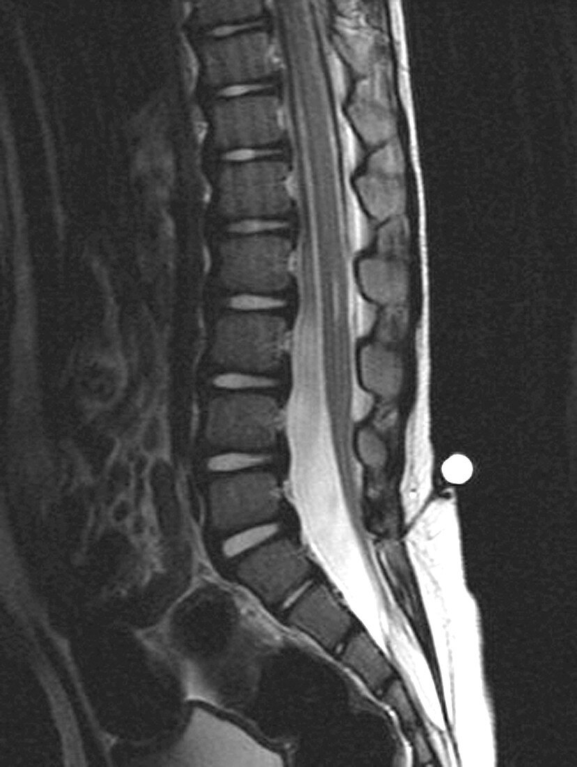 Dermal Sinus and Tethered Cord (MRI)