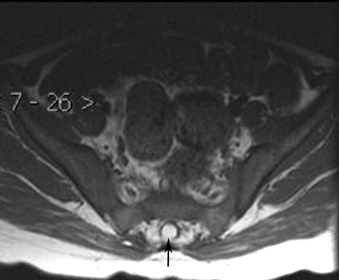 Intradural Lipoma (MRI)