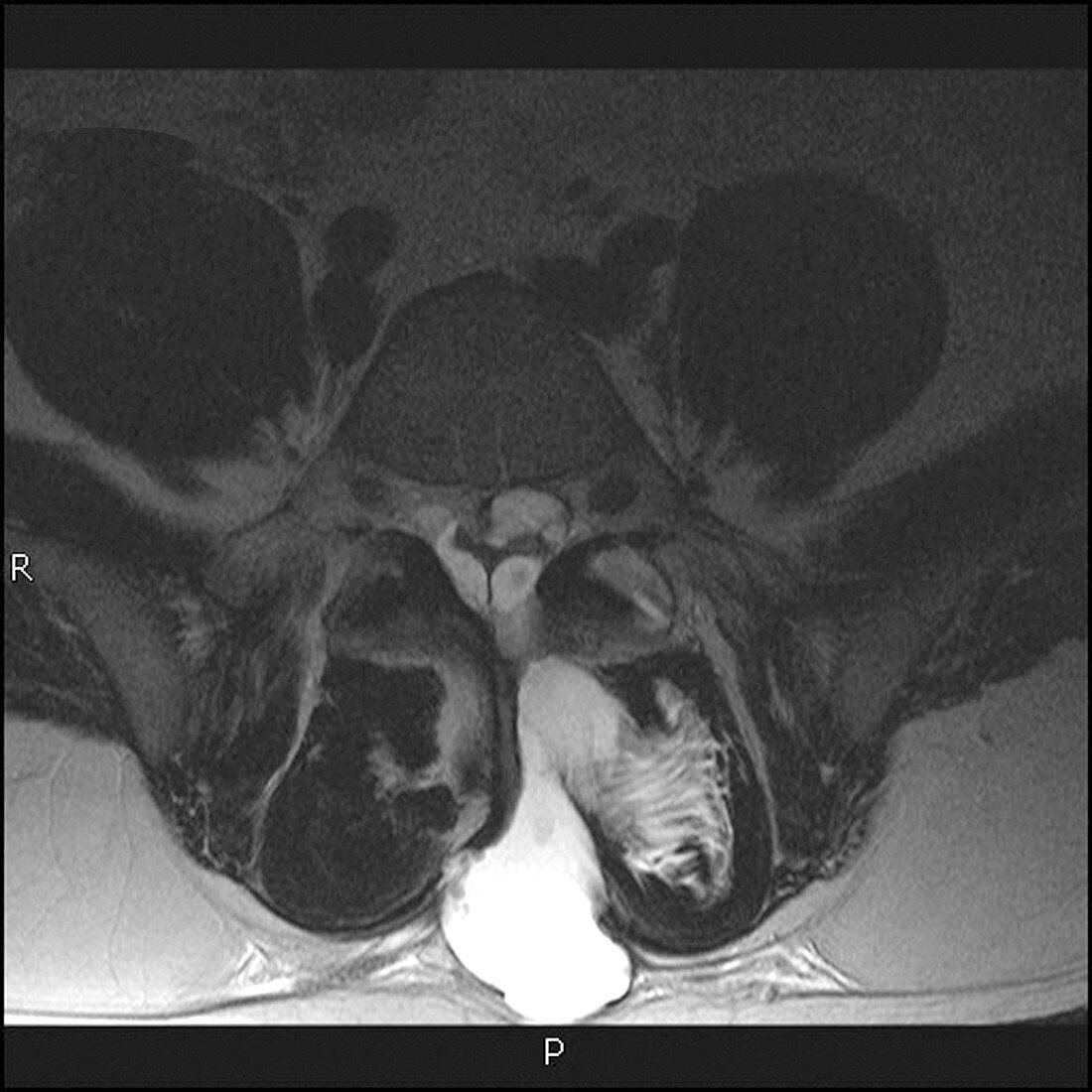 Postoperative Pseudomeningocele (MRI)