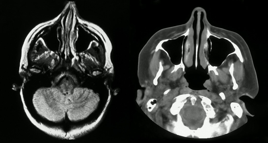 Normal Cerebral MRIs