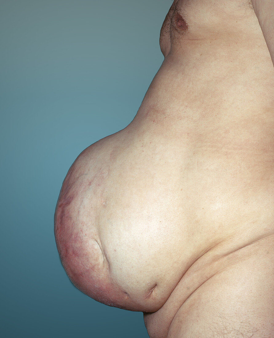 Large Abdominal Hernia