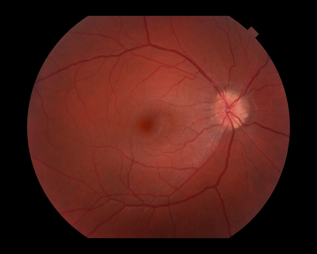 Optic Disc Drusen