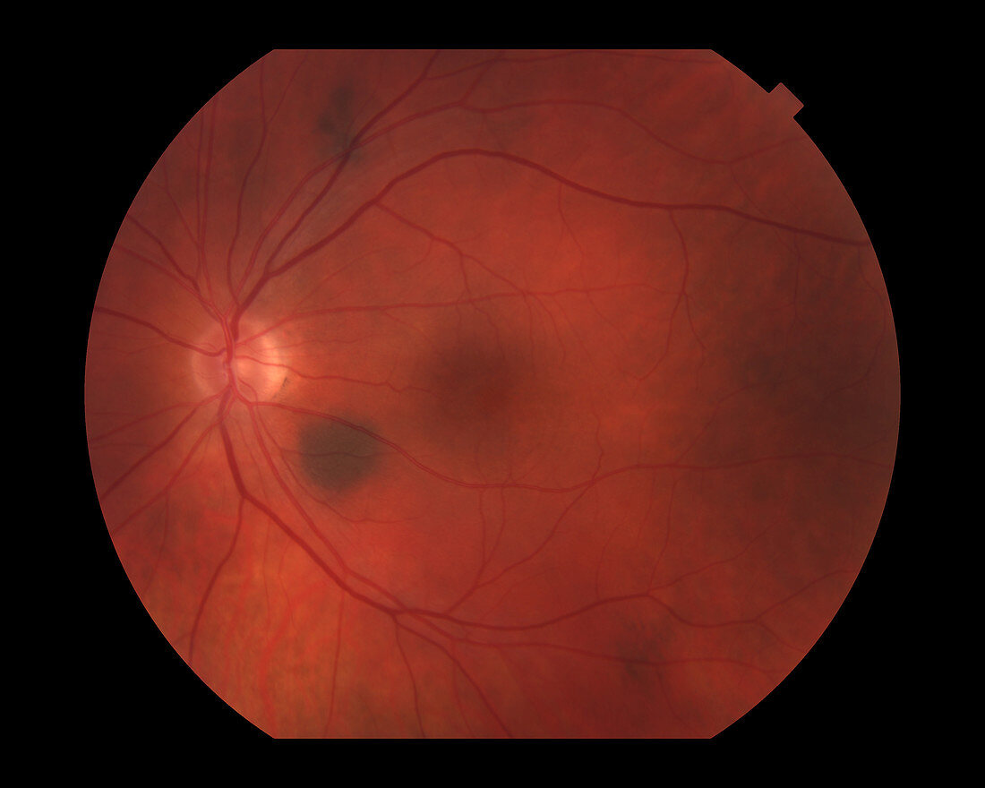 Choroidal Nevus