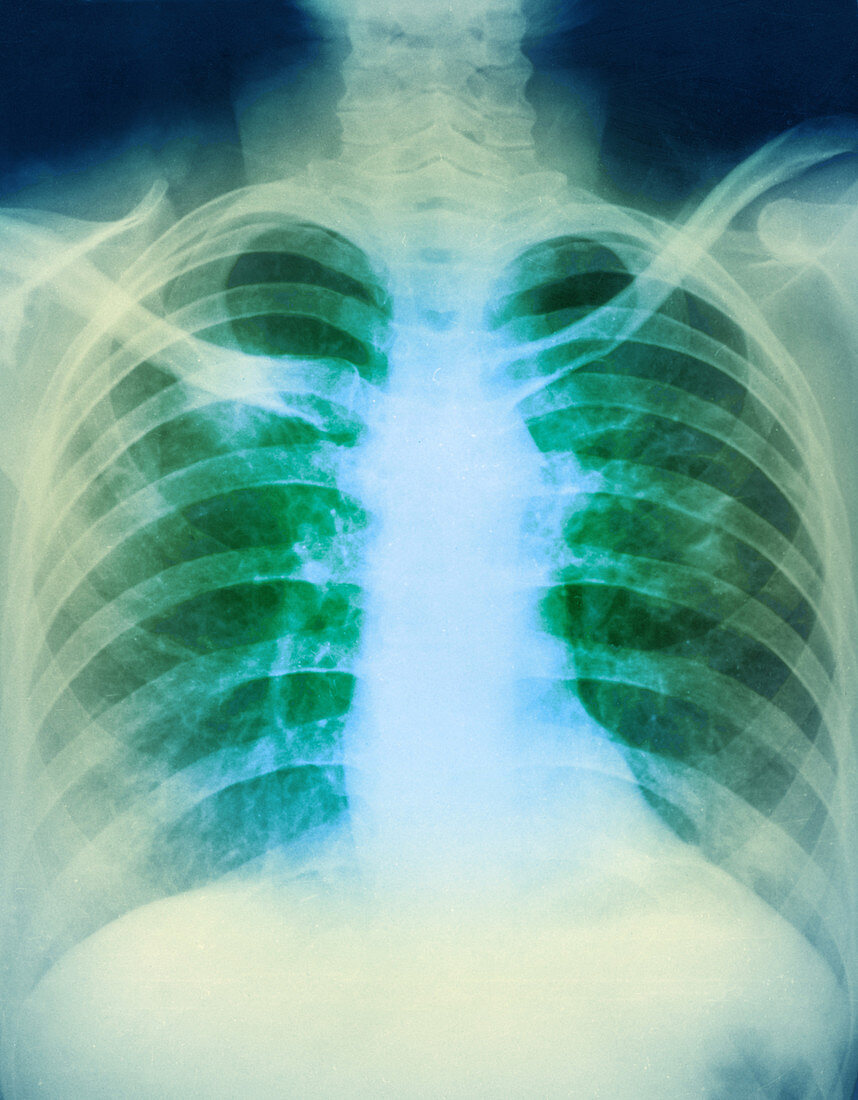 Hodgkin's Lymphoma,X-ray