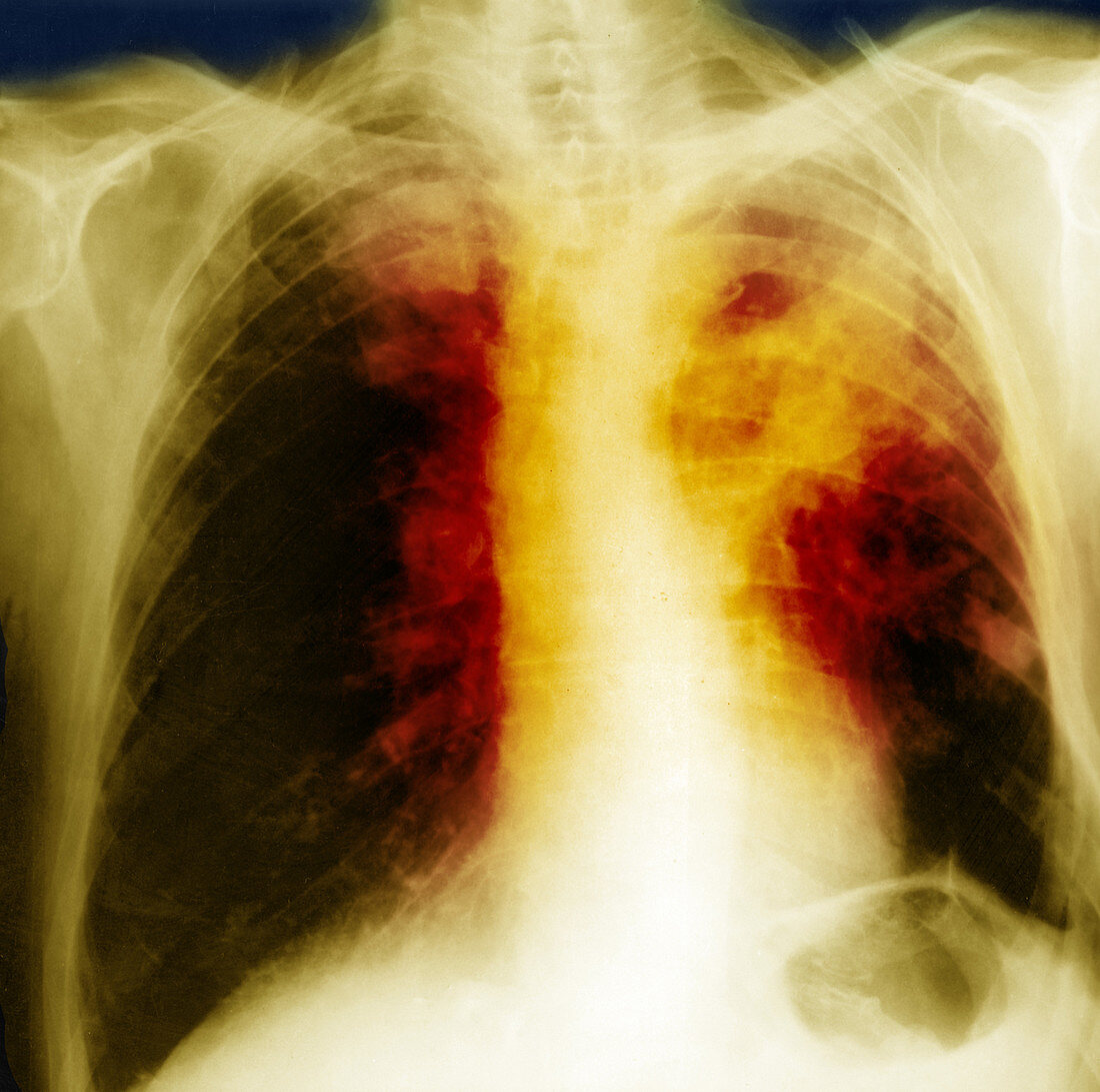 Lung Cancer,X-ray