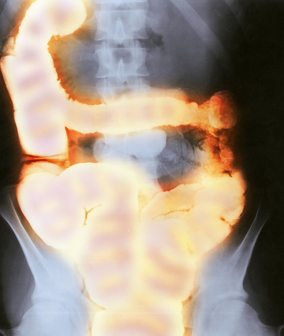 Ulcerative Colitis,X-ray