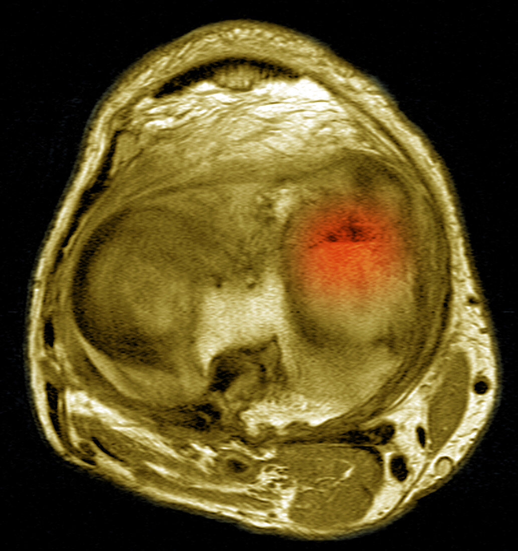Knee Arthritis,MRI