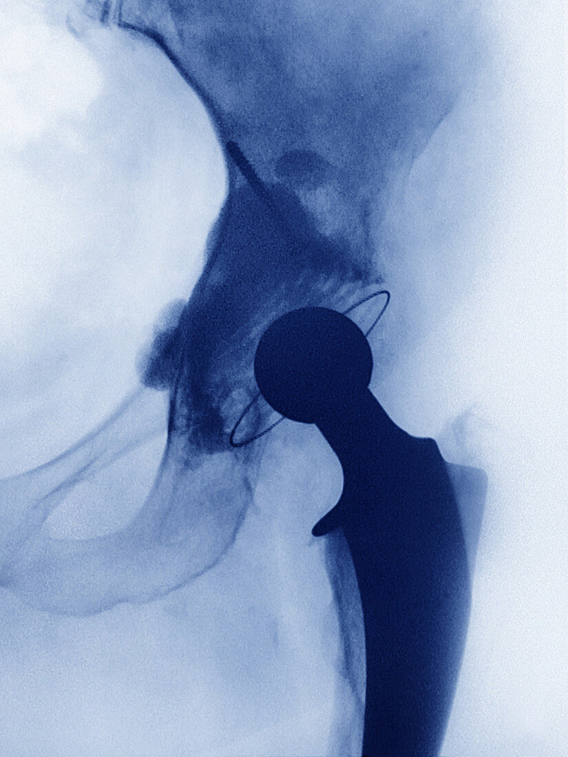 Hip Replacement,X-ray