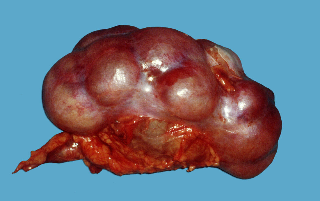Damaged Kidney from Stones in Ureter