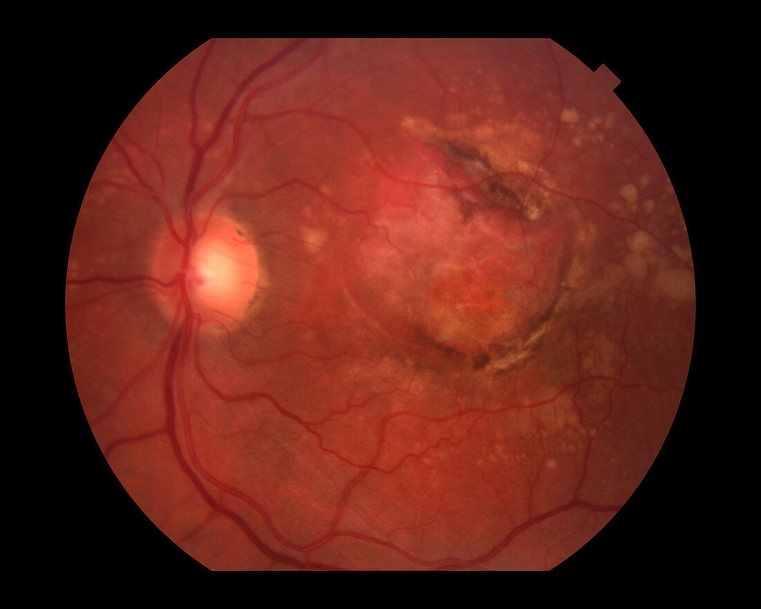 Wet Age-Related Macular Degeneration