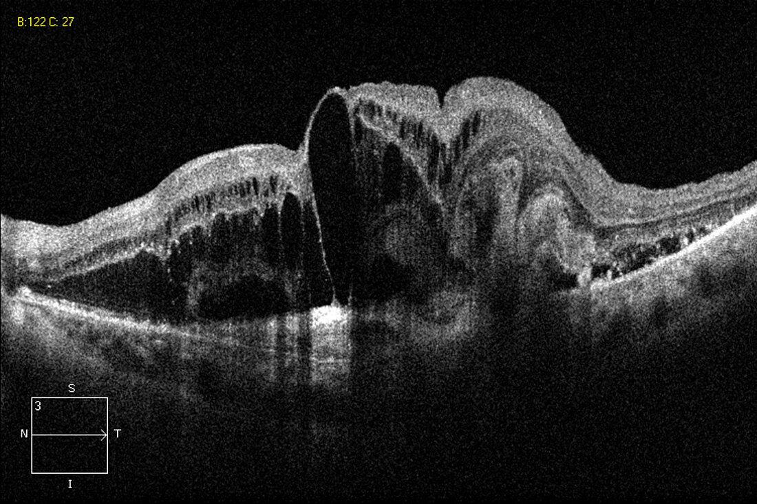 Wet Age-Related Macular Degeneration